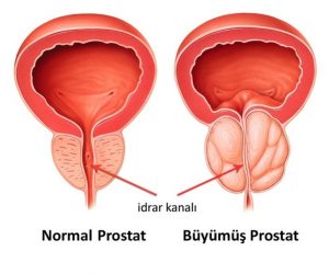 Prostat Hastalıkları